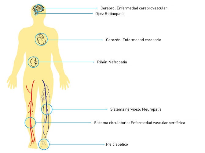 Complicaciones de la diabetes