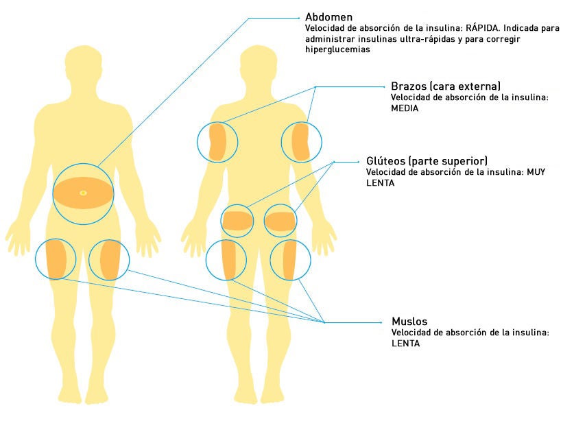 Tratamientos para la diabetes: Insulina